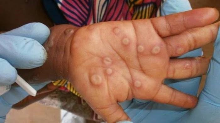 The Philippines has detected two additional new cases of monkeypox (mpox), bringing the number of active mpox cases in the country to three, the Department of Health (DOH) said on Monday.