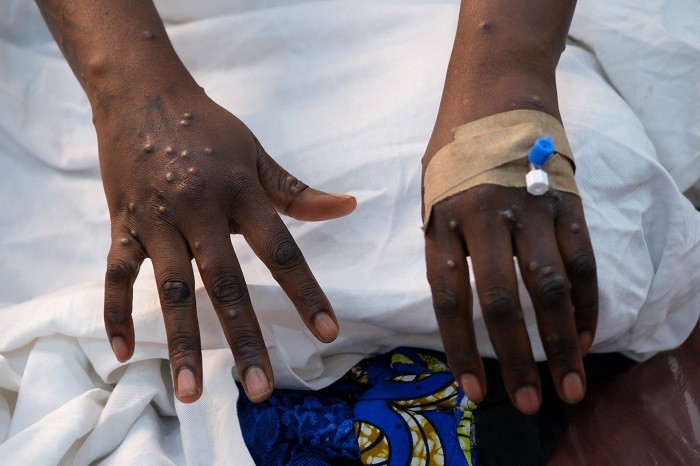 The number of mpox cases reported in Africa so far this year has surpassed 69,000, with the death toll rising to more than 1,260, Africa Centers for Disease Control and Prevention (Africa CDC) has reported.