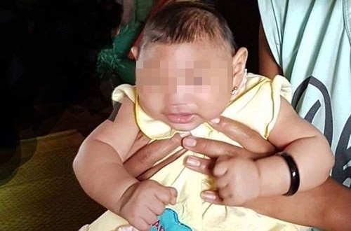 The Department of Preventive Medicine under the Ministry of Health confirmed Viet Nam’s first microcephaly case likely related to the Zika virus. (Credit: dantri.com.vn)   