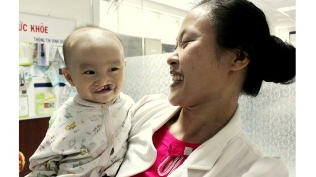 Around 300 children with cleft lips and palates will receive free surgery under the Operation Smile’s programme next month.